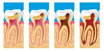 dentiste saint raphael caries plan en coupe