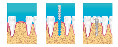 Implant dentaire Saint Raphael
