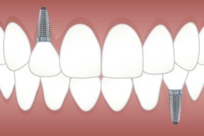 implant unitaire centre dentaire saint raphael